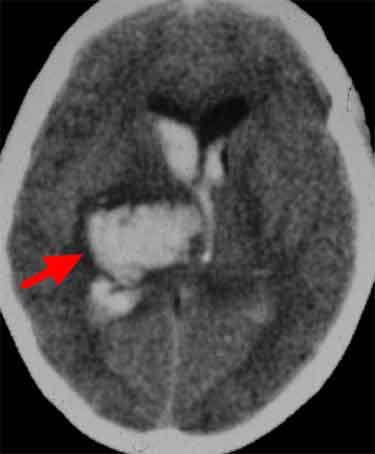 脳内血腫のCTです （赤矢印）