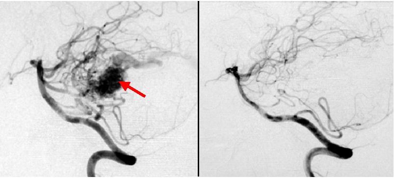 20代男性の小脳動静脈奇形です（左写真赤矢印で示す黒い塊です）。ガンマナイフ治療を行い、3年後には完全閉塞が 得られました（右写真）。