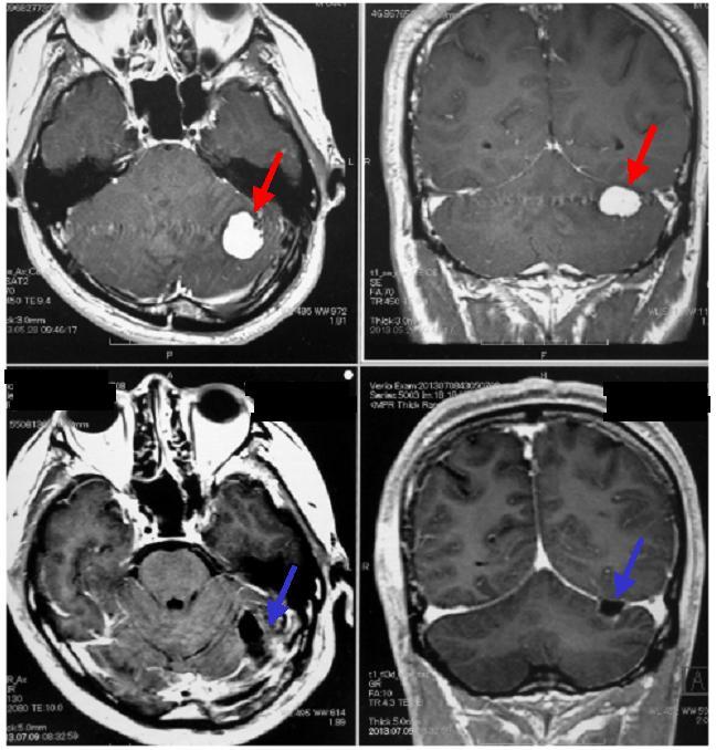 脳MRI 3 (血管障害・腫瘍・感染症・他) - 健康/医学