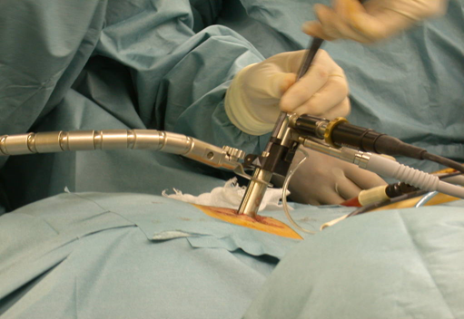 人工ディスクの交換